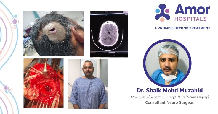 successfully removal of metal foreign body as a sequalae of blast injury